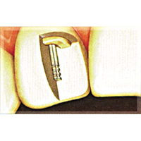 Op Po Temporary Posts Beige 1.50mm 20/pk Pack